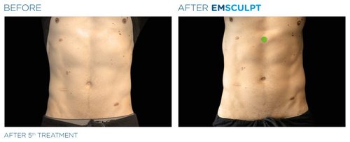EMSCULPT Before and After - Emsculpt 6
