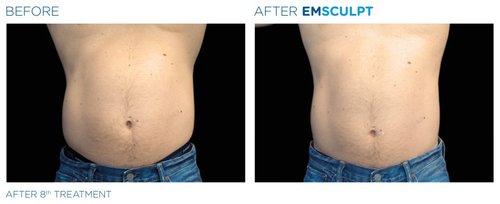 EMSCULPT Before and After - Emsculpt 7
