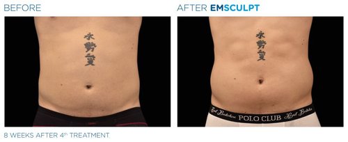 EMSCULPT Before and After - Emsculpt 8