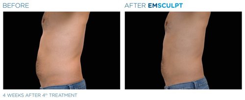 EMSCULPT Before and After - Emsculpt 9