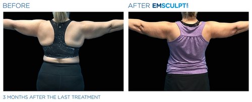 Emsculpt NEO Before and After - Emsculpt Neo PIC Ba-card-female-arms-078-B ENUS100
