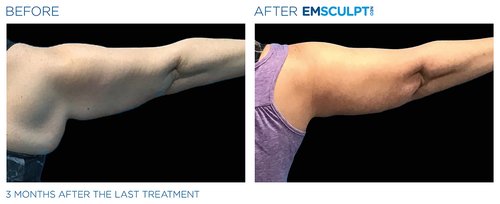 Emsculpt NEO Before and After - Emsculpt Neo PIC Ba-card-female-arms-078 ENUS100