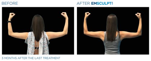 Emsculpt NEO Before and After - Emsculpt Neo PIC Ba-card-female-arms-079-B ENUS100