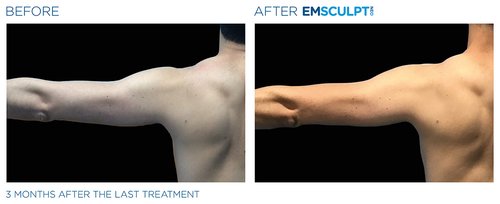 Emsculpt NEO Before and After - Emsculpt Neo PIC Ba-card-male-arms-095 ENUS100