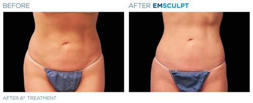 EMSCULPT Before and After - Emsculpt PIC Ba-card-female