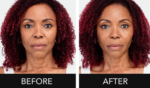 Radiesse Before and After - F8Gwkdv6g9uARkHOaevV4OuFEdZ6ucCsQg.png