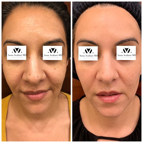 Picosure / Laser Skin Rejuvenation Before and After - IMG 0356