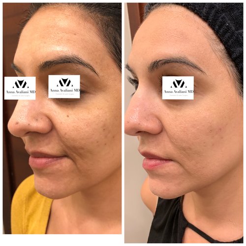 Picosure / Laser Skin Rejuvenation Before and After - IMG 0357