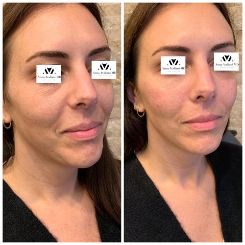 Fillers Before and After - IMG 0583