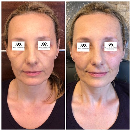 Fillers Before and After - IMG 0584