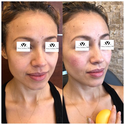 Fillers Before and After - IMG 0585