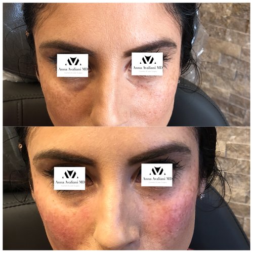 Fillers Before and After - IMG 0586