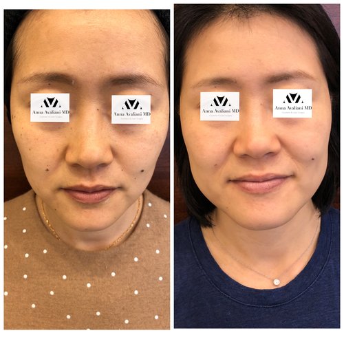 Picosure / Laser Skin Rejuvenation Before and After - IMG 1161