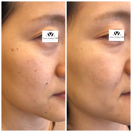Picosure / Laser Skin Rejuvenation Before and After - IMG 1162