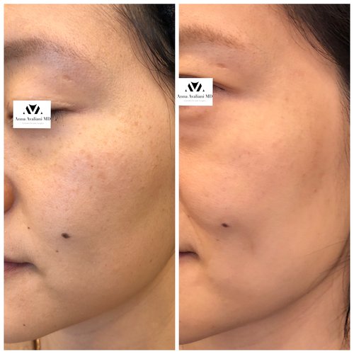 Picosure / Laser Skin Rejuvenation Before and After - IMG 1163