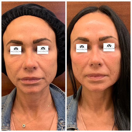 Fillers Before and After - IMG 1321