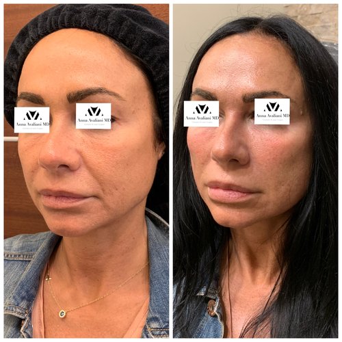 Fillers Before and After - IMG 1322