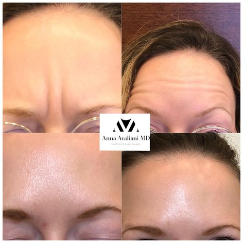 Botox Before and After - IMG 1409