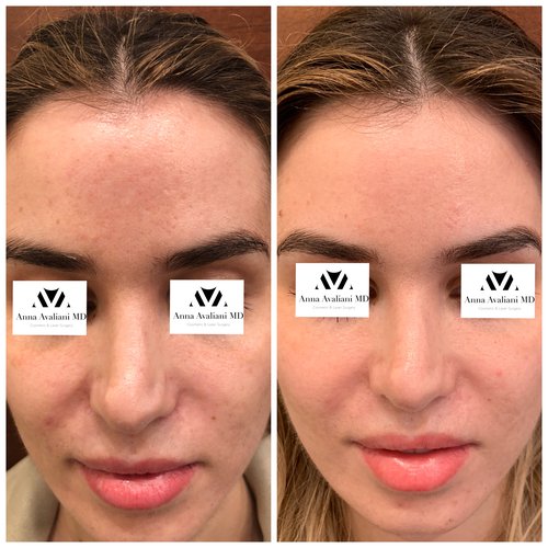 Picosure / Laser Skin Rejuvenation Before and After - IMG 1464
