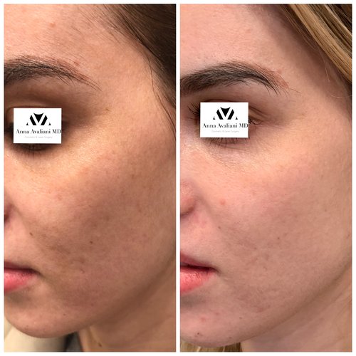 Picosure / Laser Skin Rejuvenation Before and After - IMG 1465