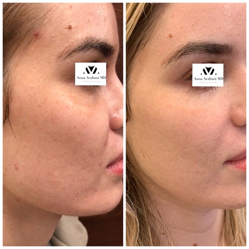 Picosure / Laser Skin Rejuvenation Before and After - IMG 1466 2