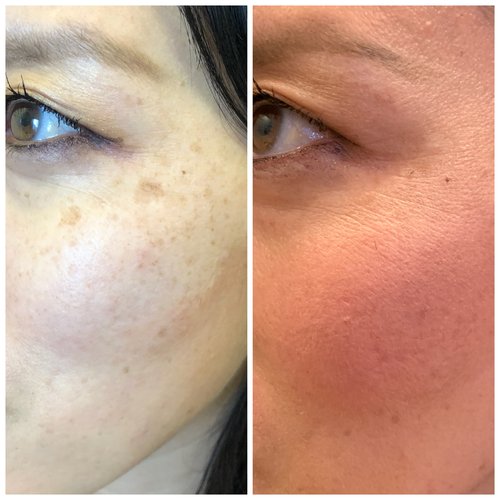 Picosure / Laser Skin Rejuvenation Before and After - IMG 1506