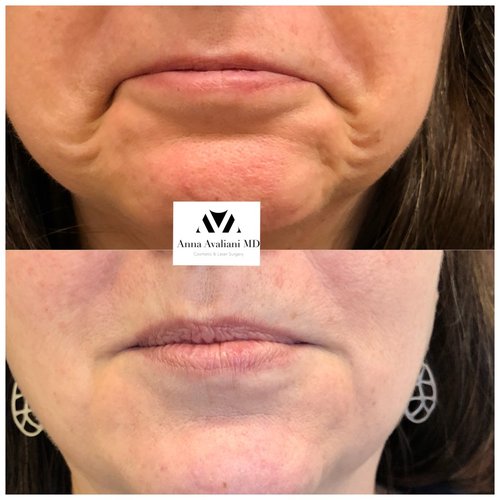 Botox Before and After - IMG 1509