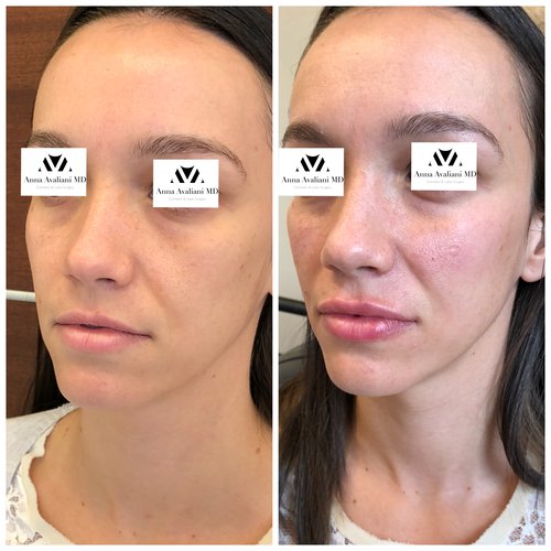 Fillers Before and After - IMG 1657