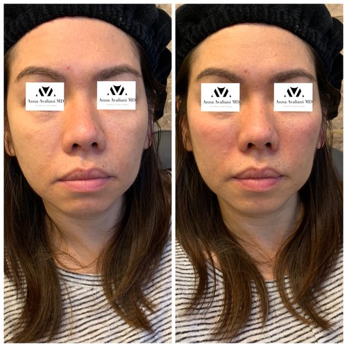 Fillers Before and After - IMG 1776