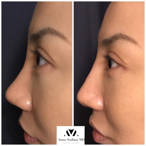 Fillers Before and After - IMG 1789