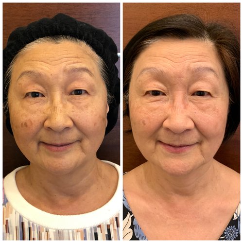 Picosure / Laser Skin Rejuvenation Before and After - IMG 3290