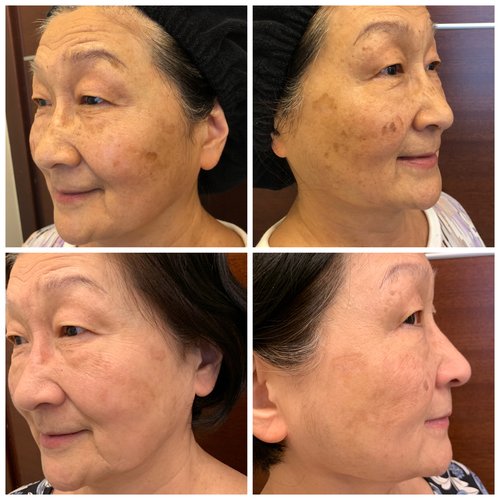 Picosure / Laser Skin Rejuvenation Before and After - IMG 3291