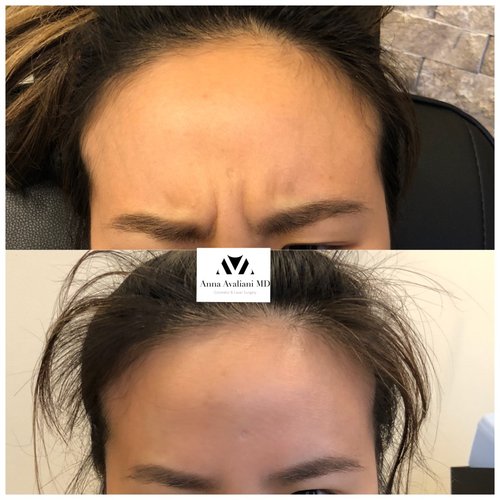 Botox Before and After - IMG 3306