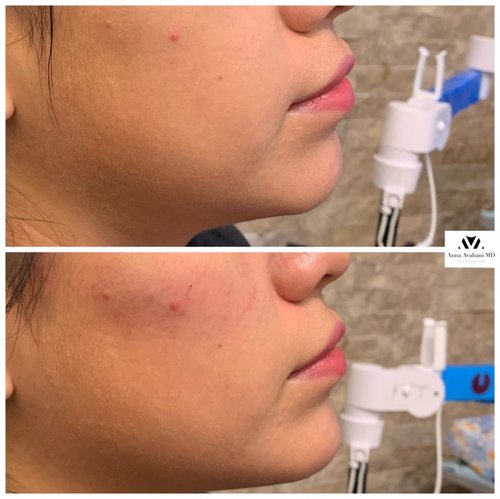 Non Surgical Chin Augmentation Before and After - IMG 3533