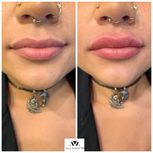 Lip Augmentation Before and After - IMG 3534