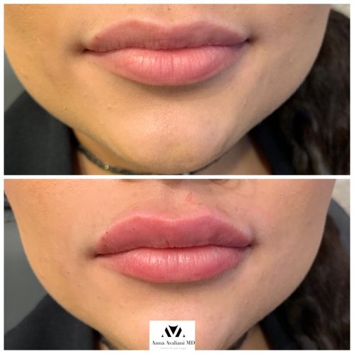 Lip Augmentation Before and After - IMG 3535