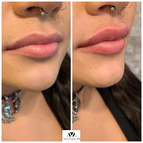 Lip Augmentation Before and After - IMG 3536
