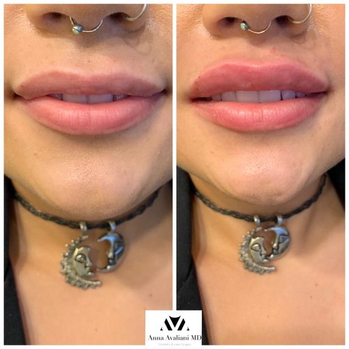 Lip Augmentation Before and After - IMG 3537
