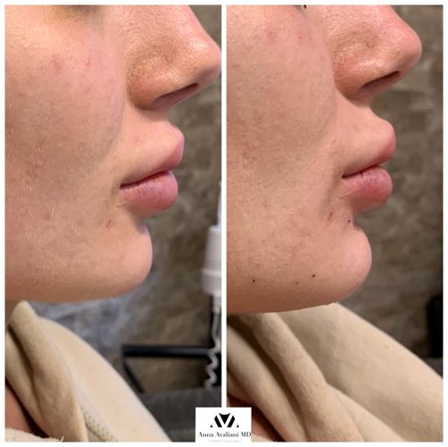Non Surgical Chin Augmentation Before and After - IMG 3540