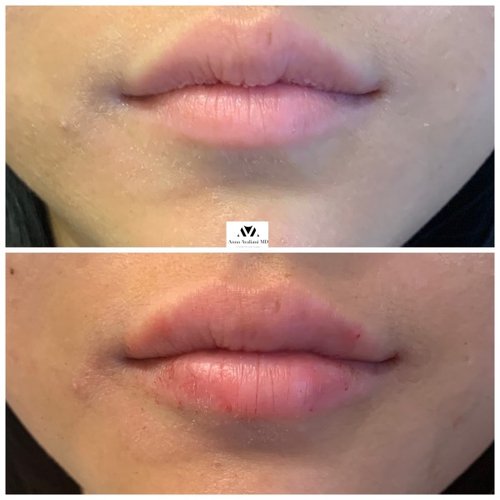 Lip Augmentation Before and After - IMG 3605