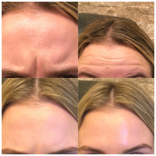 Botox Before and After - IMG 3613