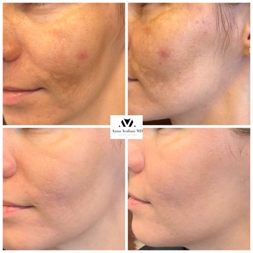 Picosure / Laser Skin Rejuvenation Before and After - IMG 3711