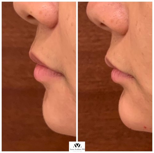 Non Surgical Chin Augmentation Before and After - IMG 3984
