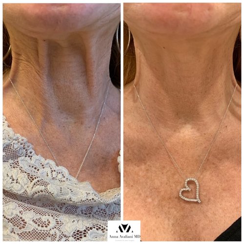 Botox Before and After - IMG 4254