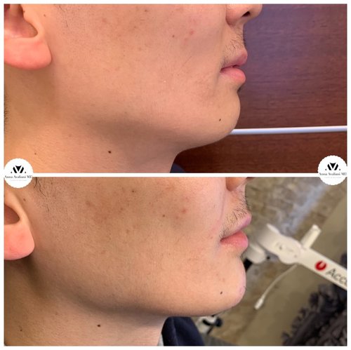Non Surgical Chin Augmentation Before and After - IMG 4540
