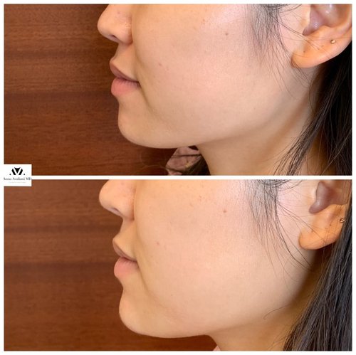 Non Surgical Chin Augmentation Before and After - IMG 4542