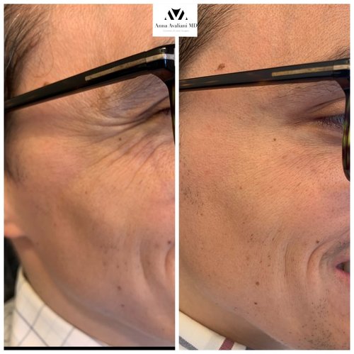 Botox Before and After - IMG 4547