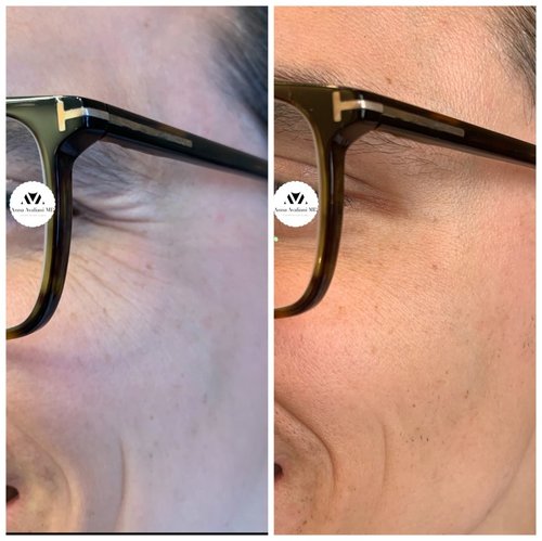 Botox Before and After - IMG 4548