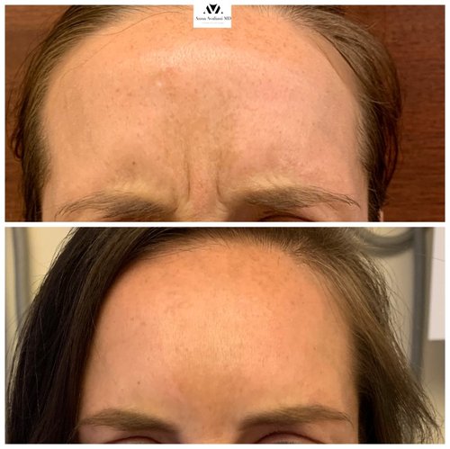 Botox Before and After - IMG 4553