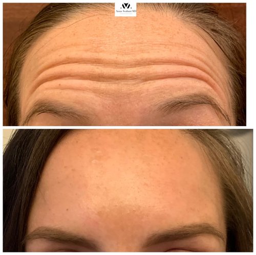 Botox Before and After - IMG 4554
